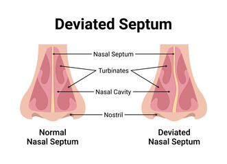 Deviated Nasal Septum Medical Vector Illustration