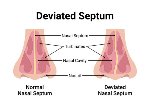 Deviated Nasal Septum Medical Vector Illustration