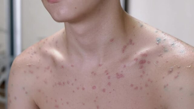 Close-up of a teenager's chest and face covered in acne. This can represent puberty, skin problems, or the need for skincare.
