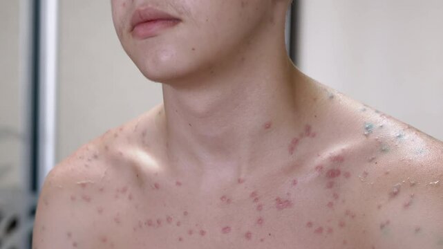 Thoughtful teenager with chickenpox rash on his chest and shoulders. Skin problems during puberty, healthcare and dermatology issues.