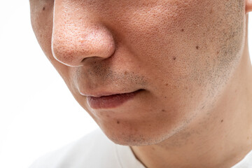 いちご鼻のクローズアップ：30代男性の毛穴と角栓