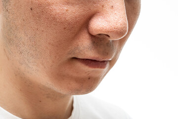 いちご鼻のクローズアップ：30代男性の毛穴と角栓