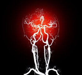 The contrast-enhanced CT Angiography (CTA) of the brain and neck, highlighting the cerebral blood...
