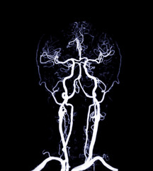 The CT Angiography (CTA) scan of the brain and neck, showcasing the intricate vascular network in...
