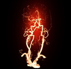 The contrast-enhanced CT Angiography (CTA) of the brain and neck, highlighting the cerebral blood...