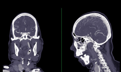 Obraz premium 3d reconstruction; anatomy; aneurysm; angiogram; angiography; artery; artery disease; basilar artery; brain; brain scan; cerebral; cerebrovascular; circle of willies; computed; computed tomography; co