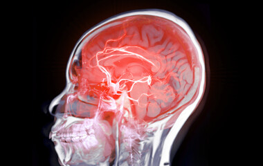 The MRA (Magnetic Resonance Angiography) scan of the brain, providing a detailed view of cerebral...