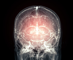 This striking image of a cerebral angiogram highlights the brain's blood vessels with a vivid red overlay. It provides a detailed view of the cranial vasculature, aiding in diagnosis and analysis.