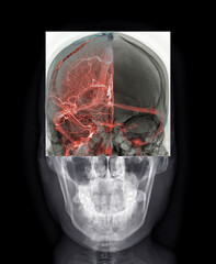 This striking image of a cerebral angiogram highlights the brain's blood vessels with a vivid red...