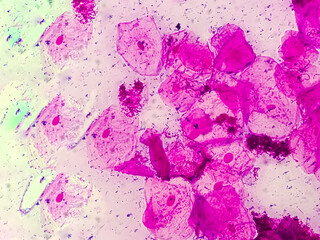 High vaginal swab gram stained microscopic show inflamatory epithelal cell and streptococcus Spp....
