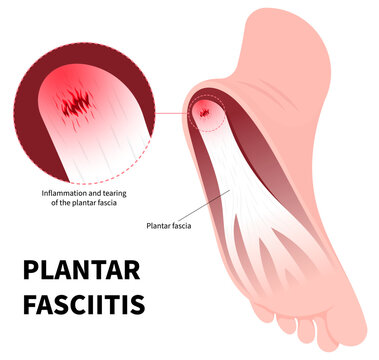 Ligament injury with heel pain and swelling in medical called Plantar Fasciitis of flat feet syndrome