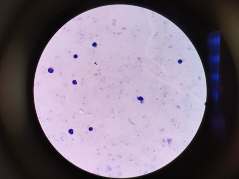 Plasmodium falciparum is a unicellular protozoan parasite of humans, and the deadliest species of Plasmodium that causes malaria in humans.