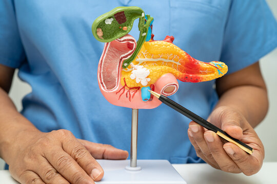 Pancreatitis, pancreatic cancer, Asian doctor with pancreas, gallbladder and bile duct human anatomy model at hospital.