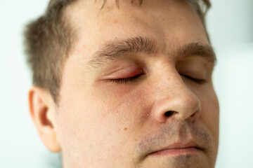 Obraz premium Selective focus on swollen and painful red upper eye lid with onset of stye infection due to clogged oil gland and staphylococcal bacteria. Close up right upper eyelid abscess.