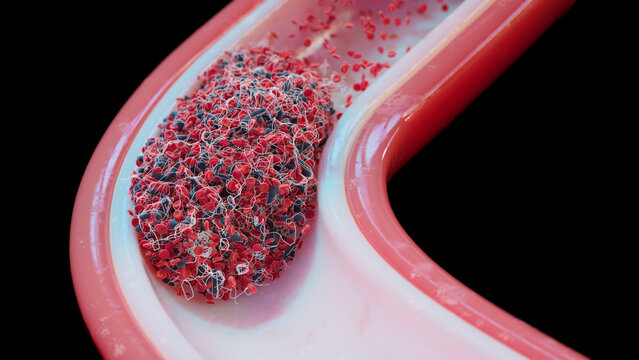 Blood clot in blood vessel, Illustration