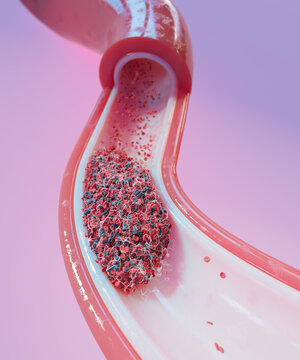 Blood clot in blood vessel, Illustration