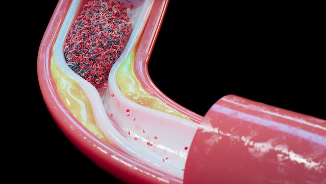 Atherosclerosis and blood clot in human blood vessel, illustration