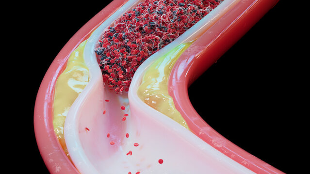 Atherosclerosis and blood clot in human blood vessel, illustration