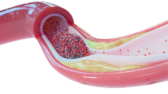 Atherosclerosis and blood clot in human blood vessel, illustration