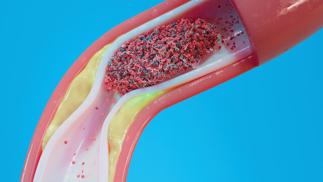 Atherosclerosis and blood clot in human blood vessel, illustration