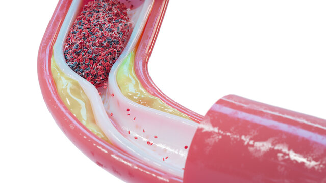 Atherosclerosis and blood clot in human blood vessel, illustration