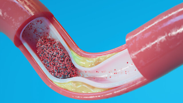 Atherosclerosis and blood clot in human blood vessel, illustration