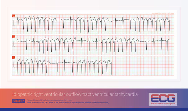 Idiopathic ventricular tachycardia originating from the right ventricular outflow tract is a benign ventricular tachycardia. This ECG shows a short burst  pattern of ventricular tachycardia.
