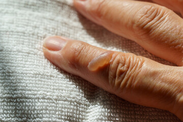 Blister on finger from thermal burn with boiling water. Hand of senior woman with second degree burns on the finger. Home accident, careless behavior with boiling tea.