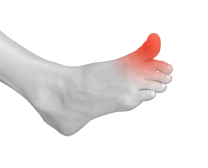 Big toe pain, foot contusion from strain or injury. Sore, tensed joints with neuropathy or arthritis. Chronic suffering, inflammation, and muscle trauma. Medical treatment for foot