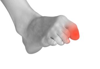 Big toe pain, joint ache, and inflammation. Sore, painful foot with neuropathy, contusion, and tensed tendon. Orthopedic treatment for arthritis and chronic inflammation. Medical