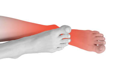 Foot pain, aching joint and inflamed bone. Female with sore feet, experiencing neuropathy, cramp, and strain. Chronic inflammation, arthritis, and numbness symptom. Medical care