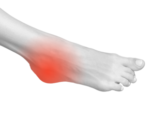 Heel pain and joint ache with neuropathy symptoms. Tensed feet with contusion, arthritis, and muscle soreness. Numbness, cramp, and strain affecting the body. Orthopedic care for