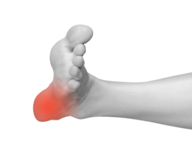 Heel pain, inflamed foot joint with soreness and injury. Chronic arthritis, gout, and neuropathy causing discomfort. Therapy and treatment for inflammation, sprain, and trauma.