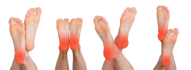 Set of female feet focusing on the heel and sole, highlighting symptoms of pain, soreness, and inflammation. Depicting conditions like arthritis, neuropathy Isolated on white