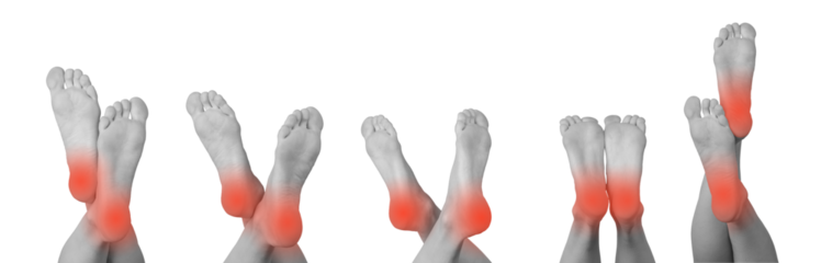 Set of female feet showing symptoms of pain and injury, including heel and sole issues like strain, redness, and numbness. arthritis, neuropathy, and gout. Isolated on white