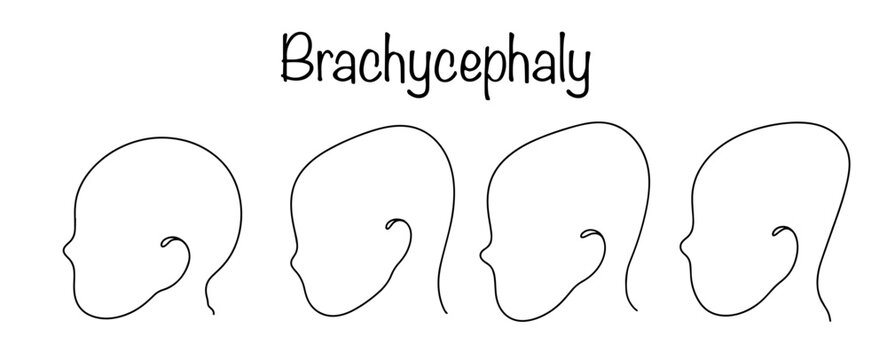 Brachycephaly