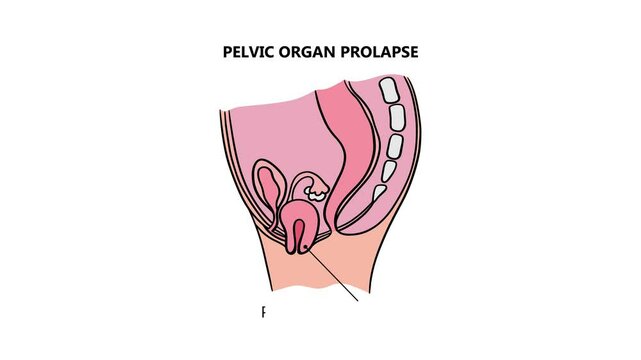 PROLAPSED UTERUS Of Women Animated Medical Education Scheme For Students Of University