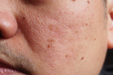 Closeup of red skin with acne, pores and moles on the face of a young Asian man Human health and...