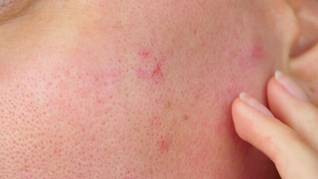 red inflammation on problematic facial skin. skin with enlarged pores. skin health concept