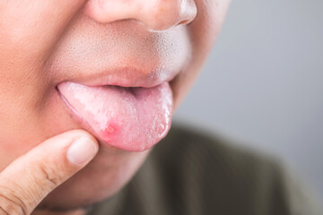 A patient's mouth showing an oral ulcer on the tip of the tongue, highlighting the discomfort and common symptoms of mouth sores