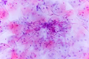 View in microscopic of Candidiasis, fungal infection (Yeast and Pseudohyphae form) in pap smear...