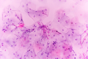 View in microscopic of Candidiasis, fungal infection (Yeast and Pseudohyphae form) in pap smear...