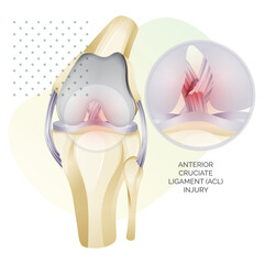 Obraz premium Knee Cartilage Anatomy - ACL Injury - Illustration