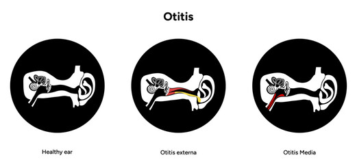 Otitis media and externa human ear anatomy disease medical infographic 