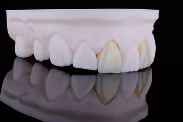 High-quality naturally dental single crowns made of zirconium for fixation to the frontal teeth of...