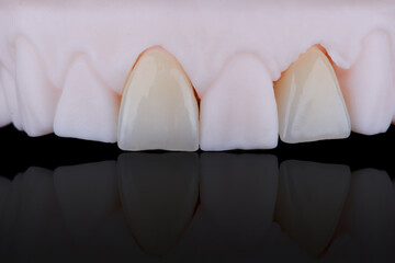 High-quality naturally dental single crowns made of zirconium for fixation to the frontal teeth of upper jaw. © gorynvd