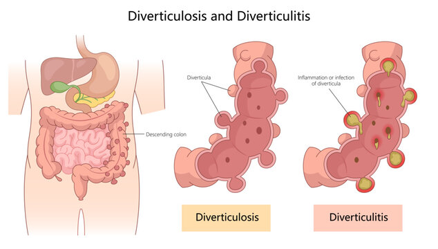 diverticulosis and diverticulitis, showing diverticula formation in the colon and inflamed or infected areas diagram hand drawn schematic vector illustration. Medical science educational illustration
