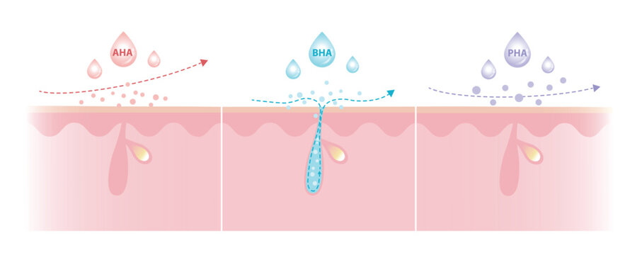 Comparison of Alpha, Beta, Poly Hydroxy Acids characteristics illustration. AHA exfoliate the surface skin. BHA penetrate deep into the pore. PHA dissolve the surface, large molecule, penetrate less.