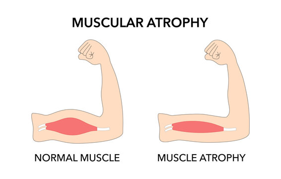 Muscular atrophy compared to healthy outline diagram. Weakness abnormal muscle and normal movement disability vector illustration.
