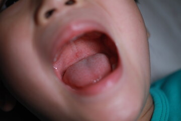 Hand Foot Mouth Disease.